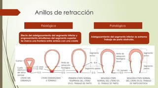 Anillos de retracción
Fisiológica Patológica
Efecto del adelgazamiento del segmento inferior y
engrosamiento simultaneo del segmento superior
Se marca una frontera entre ambos con una cresta
Adelgazamiento del segmento inferior es extremo
Trabajo de parto obstruido.
 