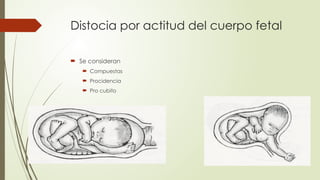Distocia por actitud del cuerpo fetal
 Se consideran
 Compuestas
 Procidencia
 Pro cubito
 