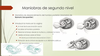Maniobras de segundo nivel
 Maniobra de desprendimiento del hombro posterior (Maniobra de
Barnum/Jacquemier)
 introducir la mano en la vagina
 A nivel de la excavación sacra
 localizar el hombro posterior
 flexionar el brazo desde la muñeca y obtener la mano
 desliza el brazo sobre el tórax
 Disminuye el diámetro biacromial en 2-3cm
 Rotación de la cintura escapular a un diámetro oblicuo
 Liberando hombro anterior
 