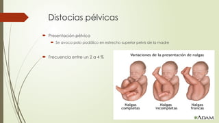 Distocias pélvicas
 Presentación pélvica
 Se avoca polo podálico en estrecho superior pelvis de la madre
 Frecuencia entre un 2 a 4 %
 