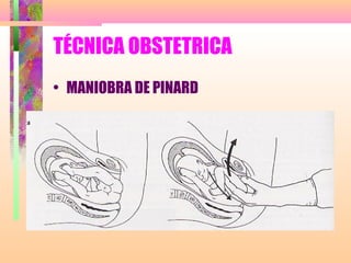 TÉCNICA OBSTETRICA
• MANIOBRA DE PINARD
 