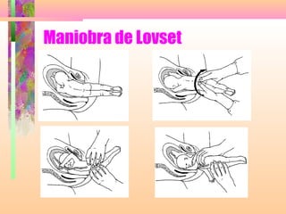 Maniobra de Lovset
 