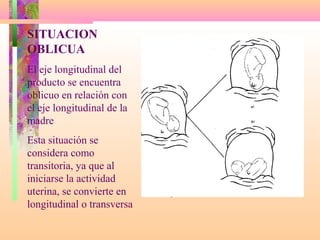 SITUACION
OBLICUA
El eje longitudinal del
producto se encuentra
oblicuo en relación con
el eje longitudinal de la
madre
Esta situación se
considera como
transitoria, ya que al
iniciarse la actividad
uterina, se convierte en
longitudinal o transversa
 