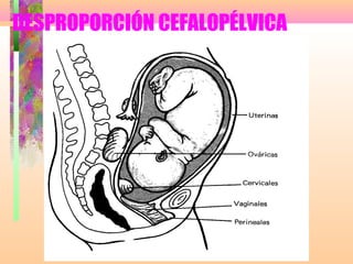 DESPROPORCIÓN CEFALOPÉLVICA
 