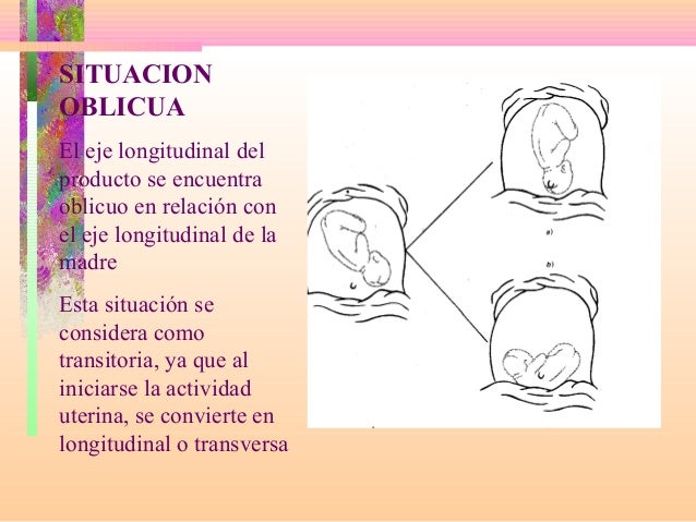 Distocias de contracción.