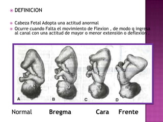  DEFINICION
 Cabeza Fetal Adopta una actitud anormal
 Ocurre cuando Falta el movimiento de Flexion , de modo q ingresa
al canal con una actitud de mayor o menor extensión o deflexión .
Normal Bregma Cara Frente
 