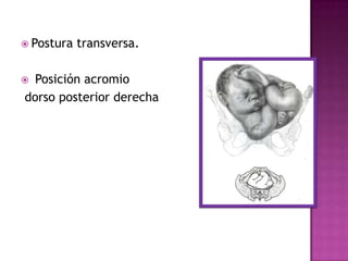  Postura transversa.
 Posición acromio
dorso posterior derecha
 