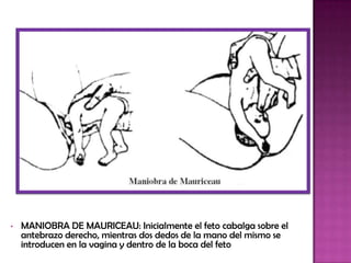 • MANIOBRA DE MAURICEAU: Inicialmente el feto cabalga sobre el
antebrazo derecho, mientras dos dedos de la mano del mismo se
introducen en la vagina y dentro de la boca del feto
 