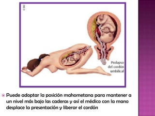  Puede adoptar la posición mahometana para mantener a
un nivel más bajo las caderas y así el médico con la mano
desplace la presentación y liberar el cordón
 
