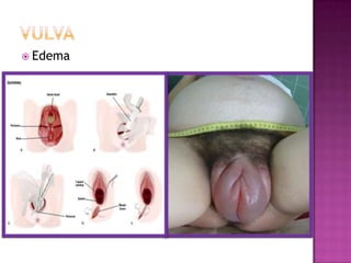  Edema
 