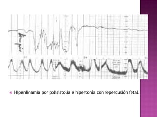  Hiperdinamia por polisistolia e hipertonía con repercusión fetal.
 