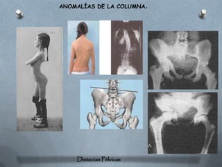 ANOMALÍAS DE LA COLUMNA.




    Distocias Pélvicas
 