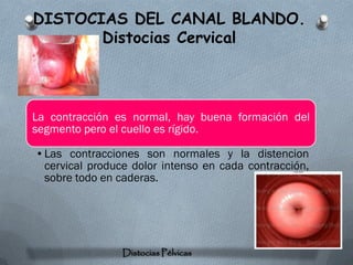 DISTOCIAS DEL CANAL BLANDO.
       Distocias Cervical



La contracción es normal, hay buena formación del
segmento pero el cuello es rígido.

•Las contracciones son normales y la distencion
 cervical produce dolor intenso en cada contracción,
 sobre todo en caderas.




                Distocias Pélvicas
 