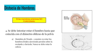 Distocia de Hombros
4. Se debe intentar rotar el hombro hasta que
coincida con el diámetro oblicuo de la pelvis
a) Maniobra de Woods → consiste en rotar los
hombros fetales ejerciendo presión sobre la
escápula y clavícula. Nunca se debe rotar la
cabeza
Si las maniobras anteriores NO
FUNCIONAN:
 