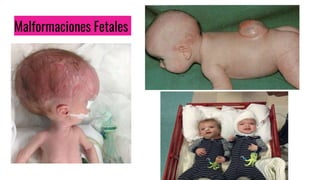 Malformaciones Fetales
 