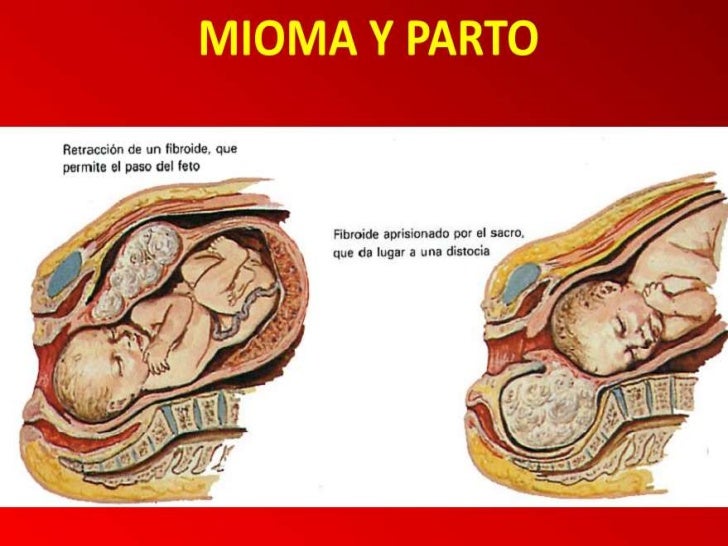 Distocias del trabajo parto