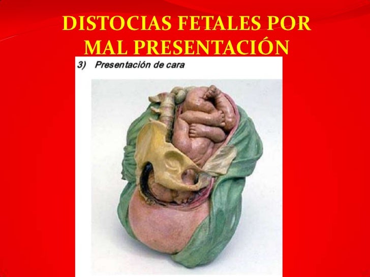 Distocias del trabajo parto