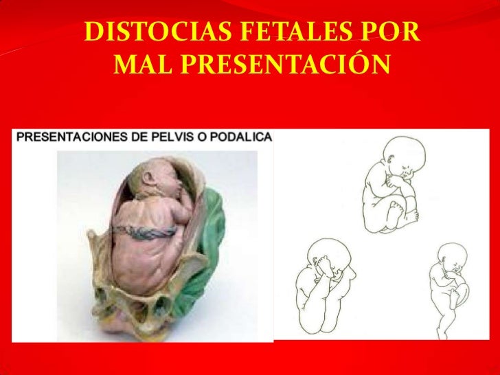 Distocias del trabajo parto
