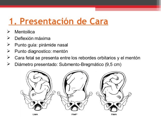 Distocias de presentacion 2014