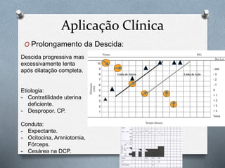 Aplicação Clínica 
O Prolongamento da Descida: 
Descida progressiva mas 
excessivamente lenta 
após dilatação completa. 
Etiologia: 
- Contratilidade uterina 
deficiente. 
- Despropor. CP. 
Conduta: 
- Expectante. 
- Ocitocina, Amniotomia, 
Fórceps. 
- Cesárea na DCP. 
 