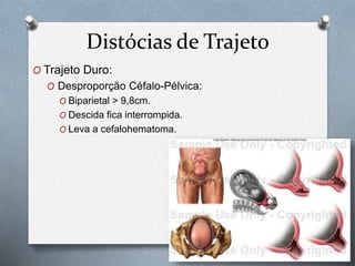 Distócias de Trajeto 
O Trajeto Duro: 
O Desproporção Céfalo-Pélvica: 
O Biparietal > 9,8cm. 
O Descida fica interrompida. 
O Leva a cefalohematoma. 
 