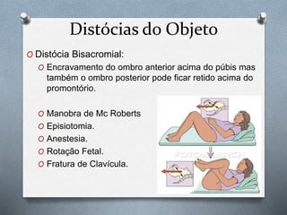 Distócias do Objeto 
O Distócia Bisacromial: 
O Encravamento do ombro anterior acima do púbis mas 
também o ombro posterior pode ficar retido acima do 
promontório. 
O Manobra de Mc Roberts 
O Episiotomia. 
O Anestesia. 
O Rotação Fetal. 
O Fratura de Clavícula. 
 