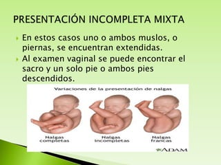 



En estos casos uno o ambos muslos, o
piernas, se encuentran extendidas.
Al examen vaginal se puede encontrar el
sacro y un solo pie o ambos pies
descendidos.

 