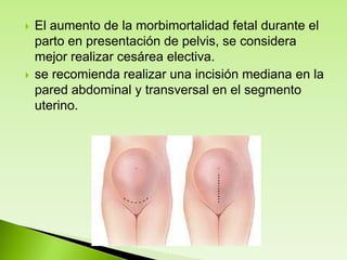 



El aumento de la morbimortalidad fetal durante el
parto en presentación de pelvis, se considera
mejor realizar cesárea electiva.
se recomienda realizar una incisión mediana en la
pared abdominal y transversal en el segmento
uterino.

 