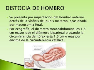 



Se presenta por impactación del hombro anterior
detrás de la sínfisis del pubis materno, ocasionada
por macrosomia fetal.
Por ecografía, el diámetro toracoabdominal es 1,5
cm mayor que el diámetro biparietal o cuando la
circunferencia del tórax está 1,6 cm o más por
encima de la circunferencia cefálica.

 