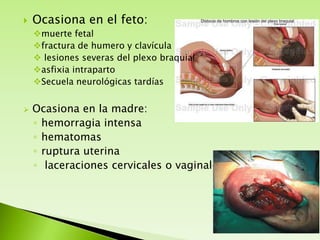 

Ocasiona en el feto:
muerte fetal
fractura de humero y clavícula
 lesiones severas del plexo braquial
asfixia intraparto
Secuela neurológicas tardías



Ocasiona en la madre:
◦ hemorragia intensa
◦ hematomas
◦ ruptura uterina
◦ laceraciones cervicales o vaginales.

 
