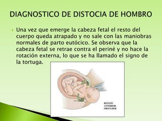 

Una vez que emerge la cabeza fetal el resto del
cuerpo queda atrapado y no sale con las maniobras
normales de parto eutócico. Se observa que la
cabeza fetal se retrae contra el periné y no hace la
rotación externa, lo que se ha llamado el signo de
la tortuga.

 