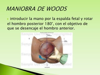 introducir la mano por la espalda fetal y rotar
el hombro posterior 180°, con el objetivo de
que se desencaje el hombro anterior.


 