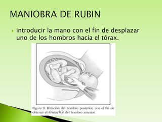 

introducir la mano con el fin de desplazar
uno de los hombros hacia el tórax.

 