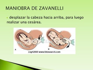 desplazar la cabeza hacia arriba, para luego
realizar una cesárea.


 
