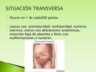 



Ocurre en 1 de cada300 partos.
causas son: prematuridad, multiparidad, tumores
uterinos, úteros con alteraciones anatómicas,
inserción baja de placenta y fetos con
malformaciones o tumores.

 