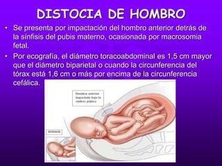 DISTOCIA DE HOMBRO
• Se presenta por impactación del hombro anterior detrás de
la sínfisis del pubis materno, ocasionada por macrosomia
fetal.
• Por ecografía, el diámetro toracoabdominal es 1,5 cm mayor
que el diámetro biparietal o cuando la circunferencia del
tórax está 1,6 cm o más por encima de la circunferencia
cefálica.
 