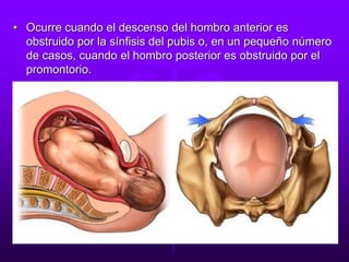 • Ocurre cuando el descenso del hombro anterior es
obstruido por la sínfisis del pubis o, en un pequeño número
de casos, cuando el hombro posterior es obstruido por el
promontorio.
 