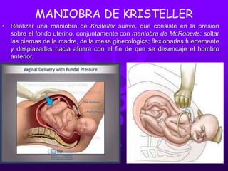 MANIOBRA DE KRISTELLER
• Realizar una maniobra de Kristeller suave, que consiste en la presión
sobre el fondo uterino, conjuntamente con maniobra de McRoberts: soltar
las piernas de la madre, de la mesa ginecológica; flexionarlas fuertemente
y desplazarlas hacia afuera con el fin de que se desencaje el hombro
anterior.
 