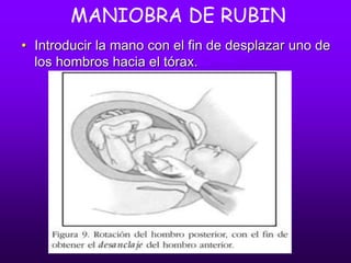 MANIOBRA DE RUBIN
• Introducir la mano con el fin de desplazar uno de
los hombros hacia el tórax.
 