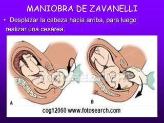 MANIOBRA DE ZAVANELLI
• Desplazar la cabeza hacia arriba, para luego
realizar una cesárea.
 