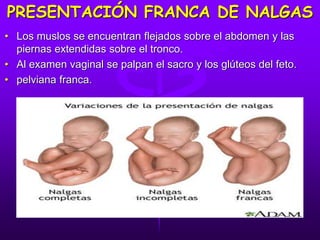 PRESENTACIÓN FRANCA DE NALGAS
• Los muslos se encuentran flejados sobre el abdomen y las
piernas extendidas sobre el tronco.
• Al examen vaginal se palpan el sacro y los glúteos del feto.
• pelviana franca.
 