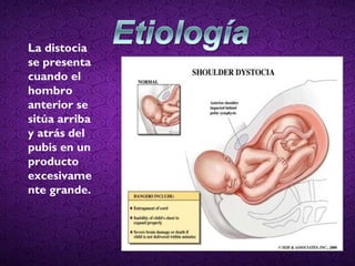 La distocia
se presenta
cuando el
hombro
anterior se
sitúa arriba
y atrás del
pubis en un
producto
excesivame
nte grande.
 