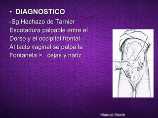 DIAGNOSTICO   -Sg Hachazo de Tarnier   Escotadura palpable entre el  Dorso y el occipital frontal  Al tacto vaginal se palpa la  Fontanela >  cejas y nariz . Manual Merck 
