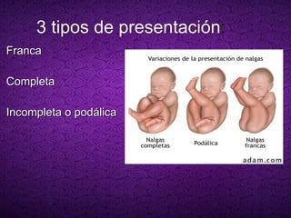 3 tipos de presentación : Franca   Completa Incompleta o podálica 