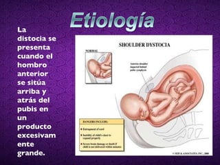 La distocia se presenta cuando el hombro anterior se sitúa arriba y atrás del pubis en un producto excesivamente grande. 