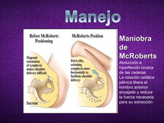 Maniobra de McRoberts Abducción e hiperflexión brusca de las caderas La rotación cefálica pélvica libera el hombro anterior encajado y reduce la fuerza necesaria para su extracción 
