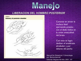 LIBERACION DEL HOMBRO POSTERIOR Consiste en atraer la muñeca fetal ejerciendo presión con el dedo índice en la unión antecubital del brazo Con esto se logra deslizar el antebrazo alrededor y por delante del pecho Manual De Obstetricia Y Ginecologia por: Benson/pernoll Editorial: Mcgraw-hill Año: 2001, 10ª  edición) 