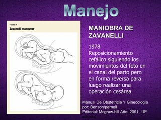 MANIOBRA DE ZAVANELLI 1978  Reposicionamiento cefálico siguiendo los movimientos del feto en el canal del parto pero en forma reversa para luego realizar una operación cesárea Manual De Obstetricia Y Ginecologia por: Benson/pernoll Editorial: Mcgraw-hill Año: 2001, 10ª  edición) 