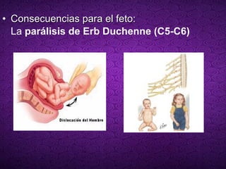 Consecuencias para el feto: La  parálisis de Erb Duchenne (C5-C6) 