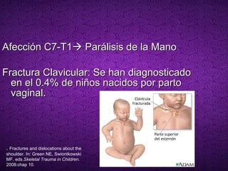 Afección C7-T1   Parálisis de la Mano Fractura Clavicular: Se han diagnosticado en el 0.4% de niños nacidos por parto vaginal.  .  Fractures and dislocations about the shoulder. In: Green NE, Swiontkowski MF, eds. Skeletal Trauma in Children . 2008:chap 10. 